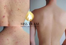 - Top 7 Spa Trị Viêm Nang Lông Uy Tín Tại HCM